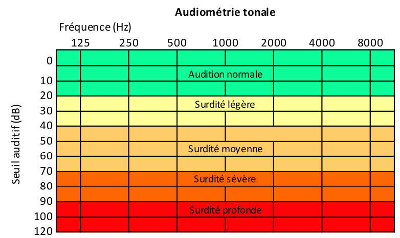 audiométrie tonale et niveau de perte d'audition classé sous BIAP